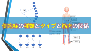 側弯症の種類とタイプと筋肉の関係